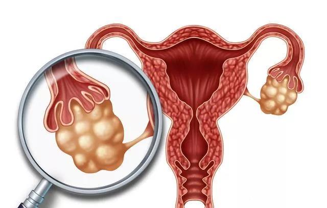 婦科“第一兇癌”！當出現這些癥狀時，婦科問題艾灸灸什么穴位