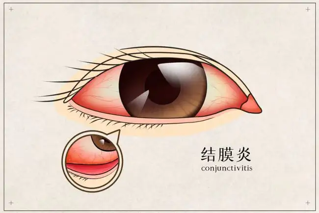 皮膚癢、拉肚子、腸胃不適、感冒，春夏換季病，艾灸來搞定！